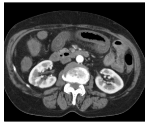 急性腸間膜閉塞CT