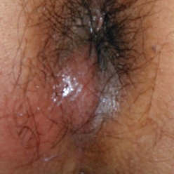 肛門周囲膿傷